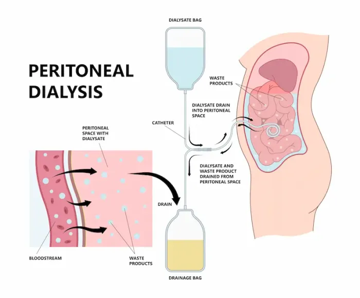 Peritoneal Disorders Overview and Treatment